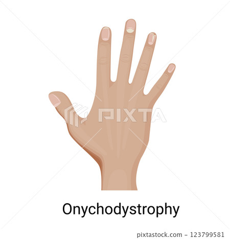 Onychodystrophy of the fingernail vector illustration. 123799581