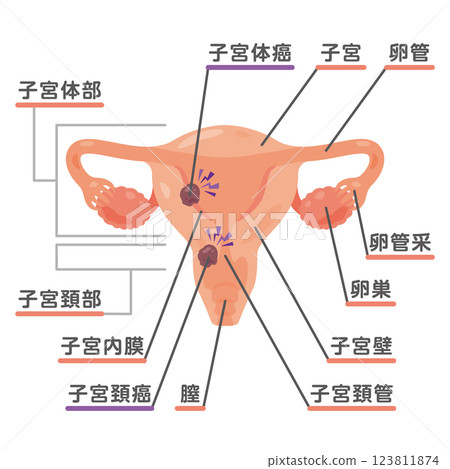 卵巢和子宮癌變的圖示 1 卵巢和子宮癌變的圖示 1 123811874