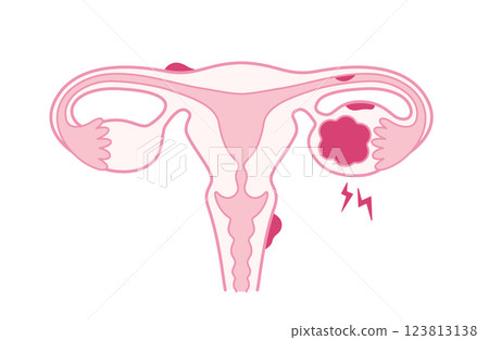 子宮內膜異位症和巧克力囊腫引起的子宮疼痛 子宮內膜異位症和巧克力囊腫引起的子宮疼痛 123813138