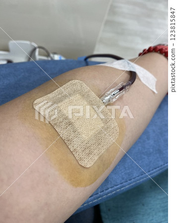 Blood Donation Process: A Woman Arm with a Needle Drawing Blood Blood Donation Process: A Woman Arm with a Needle Drawing Blood 123815847