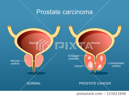 Prostate cancer. Adenocarcinoma Prostate cancer. Adenocarcinoma 123821646