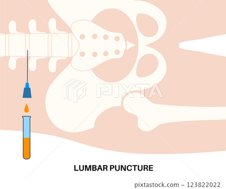 Lumbar puncture spinal tap 123822022