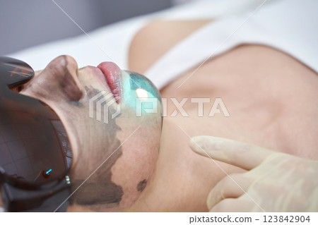 Young caucasian female receiving laser skin treatment with protective glasses Young caucasian female receiving laser skin treatment with protective glasses 123842904