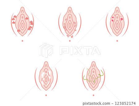 女性外生殖器疾病 女性外生殖器疾病 123852174