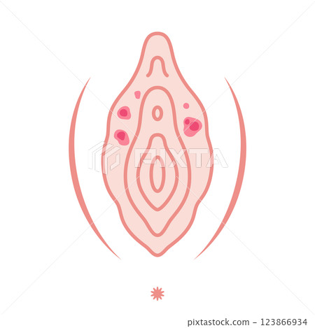 Diseases of the female external genitalia: Syphilis Diseases of the female external genitalia: Syphilis 123866934