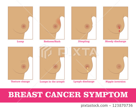 Breast cancer symptoms infographic. Methods for detecting breast cancer using self-testing for designers and illustrators. Timely care of woman health in the form of a vector illustration Breast cancer symptoms infographic. Methods for detecting breast cancer using self-testing for designers and illustrators. Timely care of woman health in the form of a vector illustration 123870736