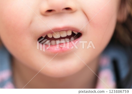 3-year-old girl with chapped lips 3-year-old girl with chapped lips 123886759
