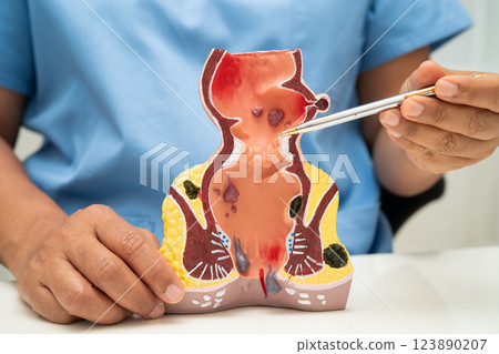 Asian doctor with rectum and hemorrhoid human anatomy model at hospital, inflamed vascular structure. Asian doctor with rectum and hemorrhoid human anatomy model at hospital, inflamed vascular structure. 123890207