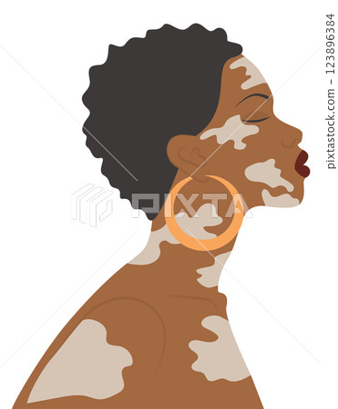 Afro-american woman illustration with vitiligo. World Vitiligo Day. Selfcare concept. Simple cartoon style 123896384