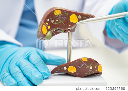 Cirrhosis, Liver cancer, fatty liver, Asian doctor with liver human anatomy model in World Hepatitis Day at hospital. 123896568
