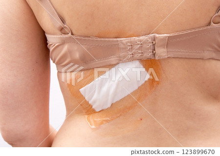 Adhesive bandage and surgical dressing after back surgery on a woman. Adhesive bandage and surgical dressing after back surgery on a woman. 123899670