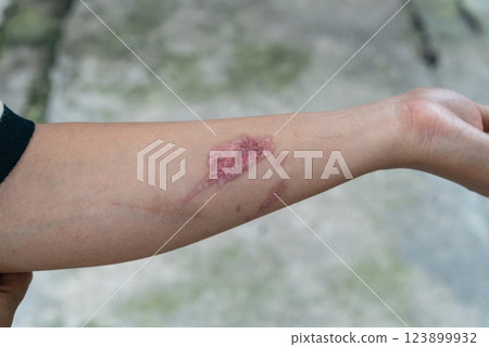 Close-up of forearm with scar tissue after burn treatment and healing 123899932