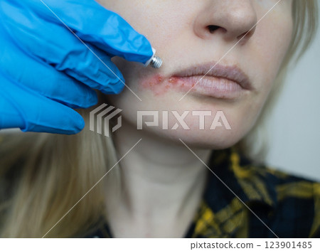 Herpes on the lips of women. A dermatologist examines and treats with ointment fever blisters of the herpes simplex virus 123901485