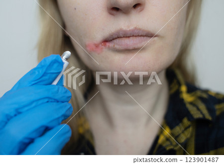 Herpes on the lips of women. A dermatologist examines and treats with ointment fever blisters of the herpes simplex virus Herpes on the lips of women. A dermatologist examines and treats with ointment fever blisters of the herpes simplex virus 123901487