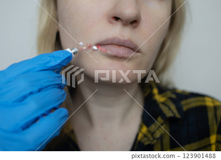 Herpes on the lips of women. A dermatologist examines and treats with ointment fever blisters of the herpes simplex virus Herpes on the lips of women. A dermatologist examines and treats with ointment fever blisters of the herpes simplex virus 123901488