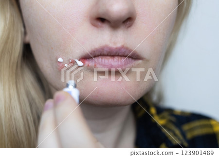 Herpes on the lips of women. A dermatologist examines and treats with ointment fever blisters of the herpes simplex virus Herpes on the lips of women. A dermatologist examines and treats with ointment fever blisters of the herpes simplex virus 123901489