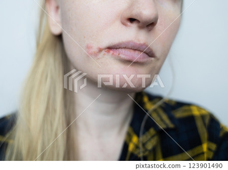 Herpes on the lips of women. A dermatologist examines and treats with ointment fever blisters of the herpes simplex virus 123901490