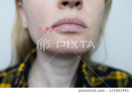 Herpes on the lips of women. A dermatologist examines and treats with ointment fever blisters of the herpes simplex virus 123901491
