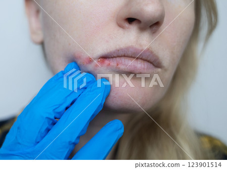 Herpes on the lips of women. A dermatologist examines and treats with ointment fever blisters of the herpes simplex virus 123901514