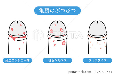 Bumps on male genitals - types of sexually transmitted diseases 123929654