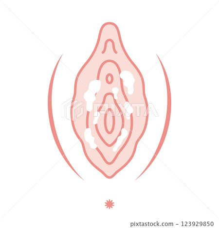 女性外生殖器疾病：念珠菌病 123929850