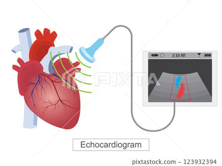 An echocardiogram (echo) is a test that use high frequency sound waves. 123932394