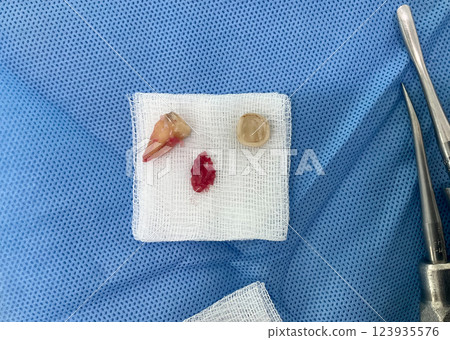 Extracted teeth and gauze placed on a blue surgical drape, indicating preparation for a dental procedure. Top view Extracted teeth and gauze placed on a blue surgical drape, indicating preparation for a dental procedure. Top view 123935576