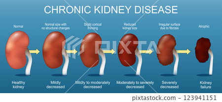 Chronic kidney disease. Stages 123941151