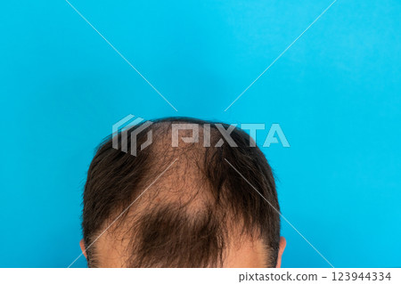 Close-up of a balding head of a young man on a blue isolated background. Close-up of a balding head of a young man on a blue isolated background. 123944334