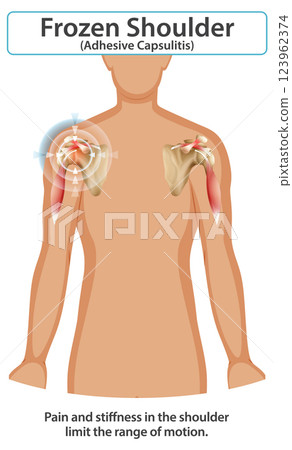 Understanding Frozen Shoulder Anatomy 123962374