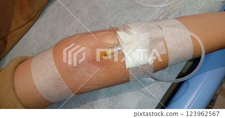 An IV drip in a child's arm An IV drip in a child's arm 123962567
