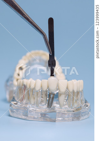 Dental shade guide held by tweezers, comparing tooth color on a transparent implant model for restorative and cosmetic dentistry. 123999435