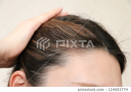 Women who are concerned about the progression of FAGA Women who are concerned about the progression of FAGA 124003774