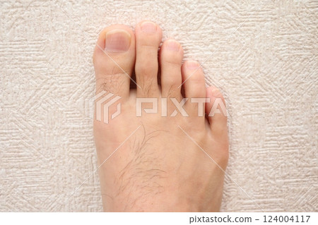 Hypertrichosis instep 124004117