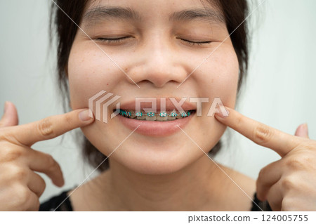 Asian woman with dental braces orthodontic treatment dental care. Asian woman with dental braces orthodontic treatment dental care. 124005755