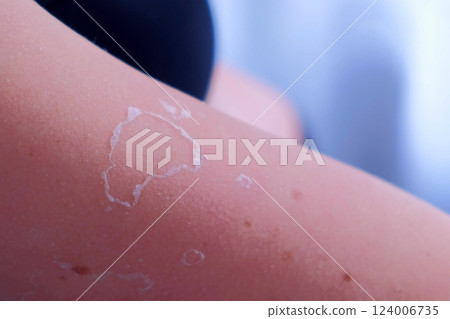 Woman with peeling skin from UV sunburn on legs and tummy, closeup. 124006735