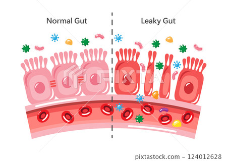 Leaky gut syndrome and healthy gut . Cute medical cartoon . Vector . Leaky gut syndrome and healthy gut . Cute medical cartoon . Vector . 124012628