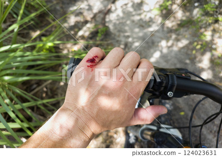 Mountain bike accident. Rider hand wound with red blood from hitting a tree stump 124023631