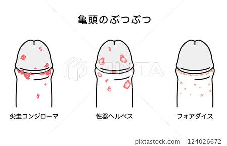 Bumps on male genitals - types of sexually transmitted diseases Bumps on male genitals - types of sexually transmitted diseases 124026672