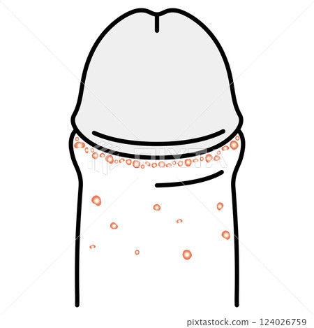 Fordyce spots: bumps on the male genitals Fordyce spots: bumps on the male genitals 124026759