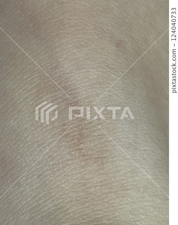 皮膚,特寫,傷口,癒合 皮膚,特寫,傷口,癒合 124040733