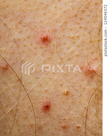 Closeup skin with acne moles and red spots. 124046372