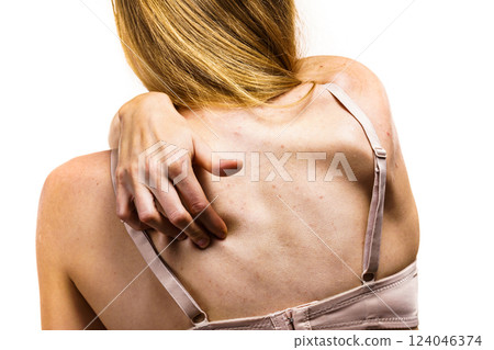 Woman with skin problem acne on back 124046374