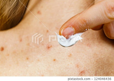 Woman with pimple on back applying medical ointmeny 124046436