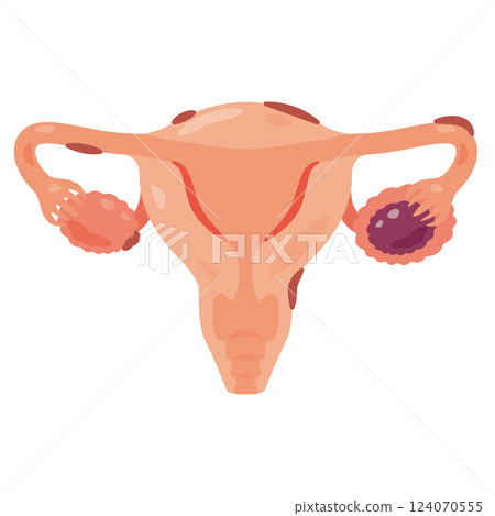 Illustration of a uterus with endometriosis 2 124070555