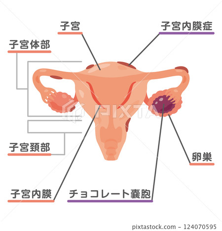 子宮內膜異位症 1 子宮圖示 124070595