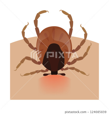 Encephalitis tick biting human skin causing lyme disease 124085839
