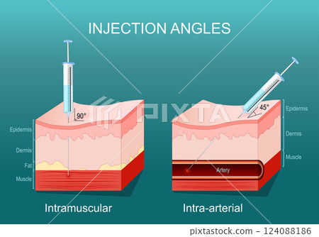 Intra-arterial and Intramuscular injections 124088186