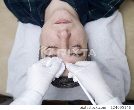 Man undergoing facial cleansing and blackhead removal. Beautician using comedone extractor or uno loop. Professional skin care in a beauty salon Man undergoing facial cleansing and blackhead removal. Beautician using comedone extractor or uno loop. Professional skin care in a beauty salon 124095146