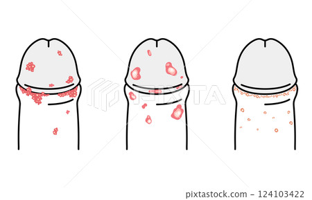 Bumps on male genitals - types of sexually transmitted diseases 124103422